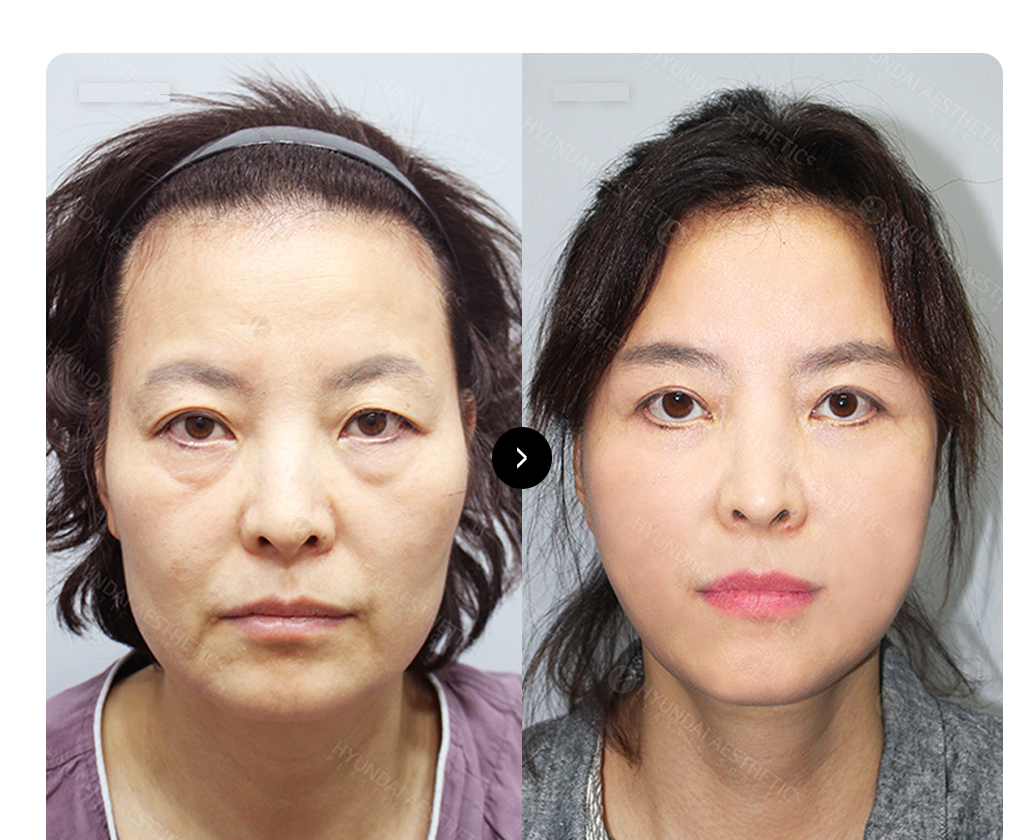 SMAS 面部提升 BEFORE & AFTER — 术前术后对比