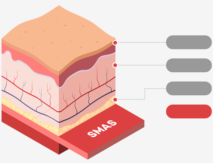展示表皮层、真皮层、皮下脂肪层、SMAS 层的皮肤剖面插图