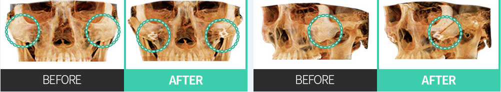 CASE 02 后上方重新定位 — 正面·侧面 CT BEFORE / AFTER 对比