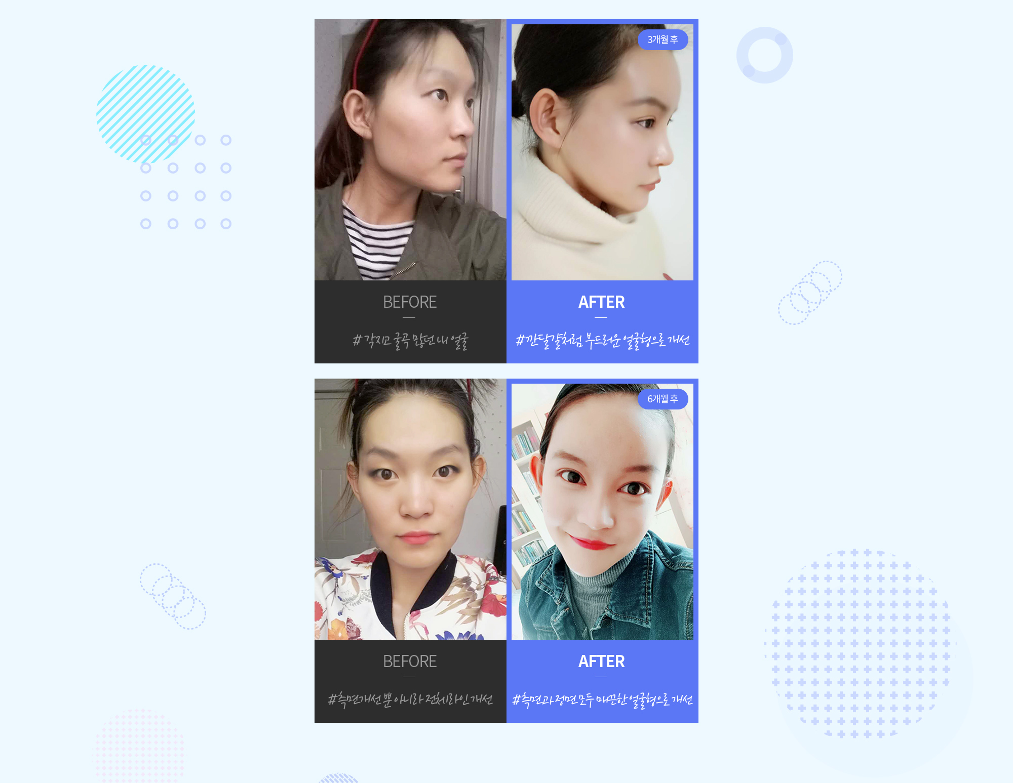 现代美学颧骨缩小术 REAL 前后照片 — CASE 1: 正面·侧面 BEFORE/AFTER (#棱角明显、曲线较多的我的脸 → #改善为像剥壳鸡蛋般柔和的脸型,6个月后). CASE 2: 正面·侧面 BEFORE/AFTER (#不仅改善侧面,也改善整体线条 → #侧面和正面都改善为流畅脸型,6个月后).