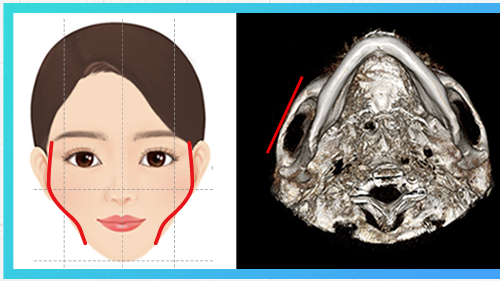 侧颧突出型 — 颧骨示意图 + CT