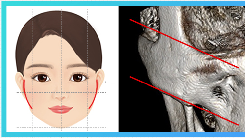 颧骨整体较宽类型 — 颧骨示意图 + CT