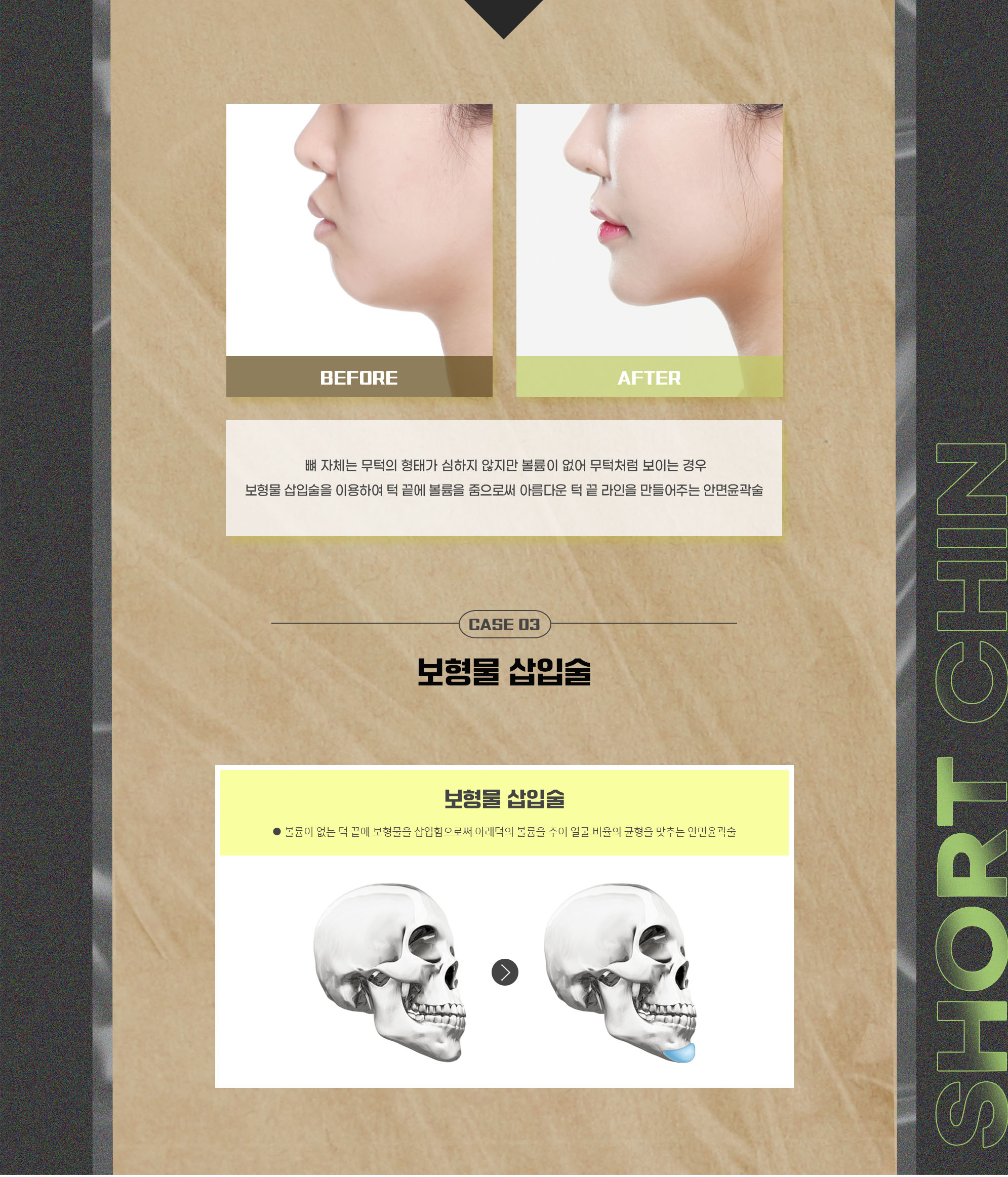 CASE 03 缺乏立体感且下巴后缩 — 手术前后照片及假体植入术介绍