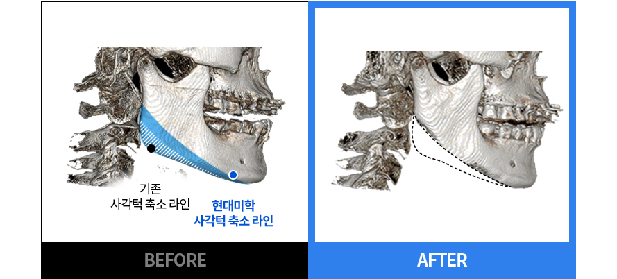 原有方颌线条与 现代美学 方颌缩小线条 BEFORE / AFTER CT 对比