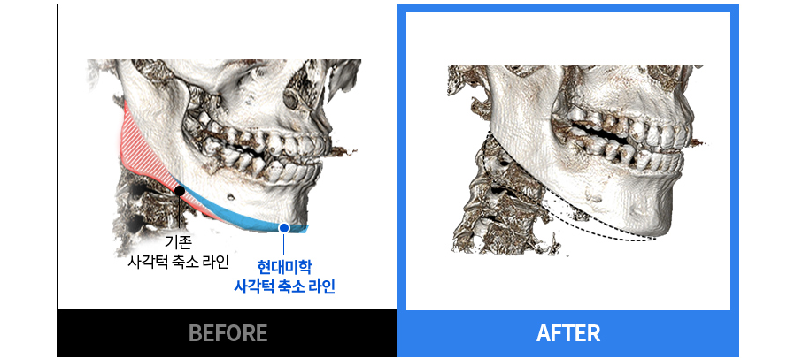 原有方颌线条与 现代美学 方颌缩小线条 BEFORE / AFTER CT 对比