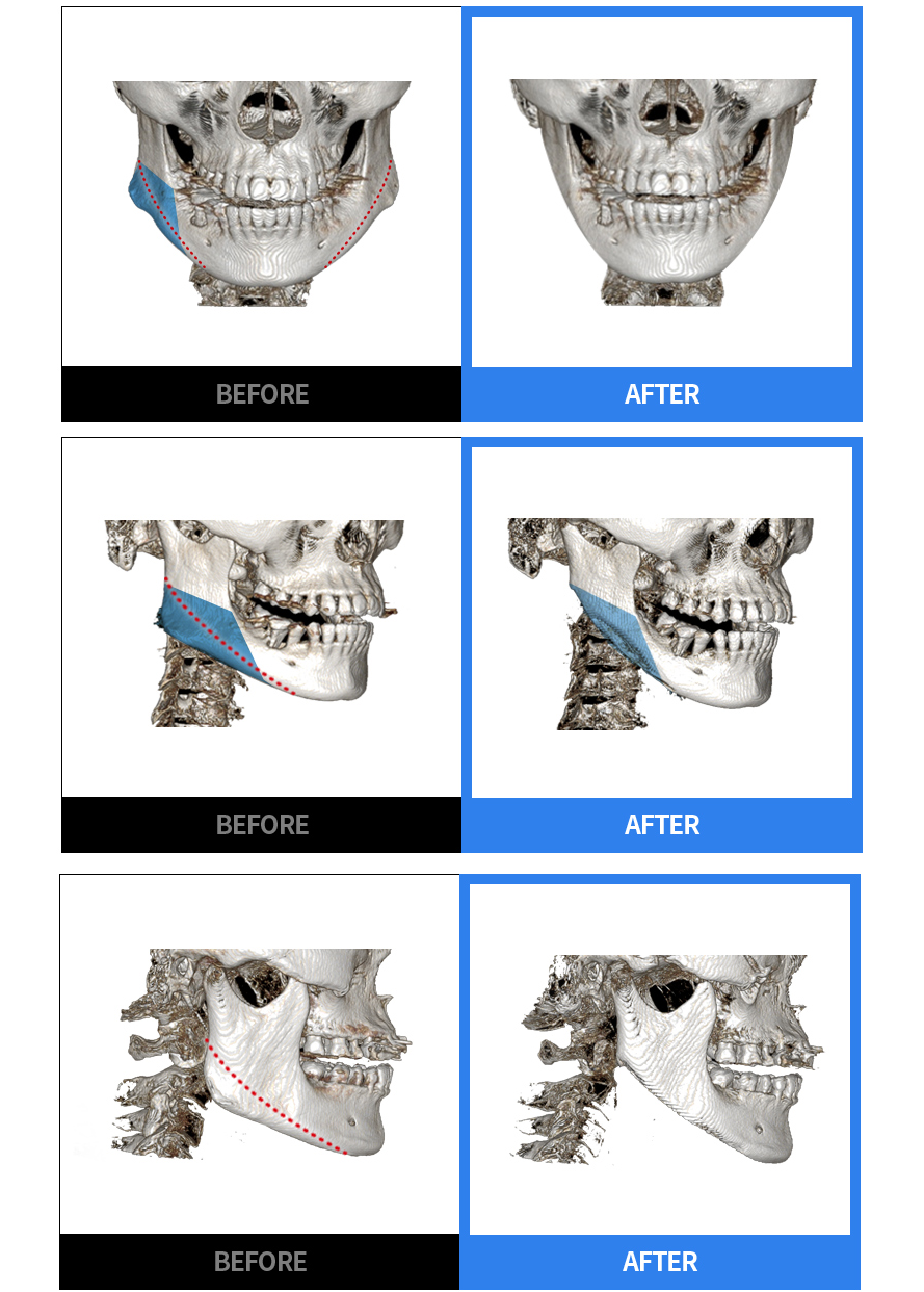 方颌缩小前后正面·侧面 BEFORE / AFTER CT 对比