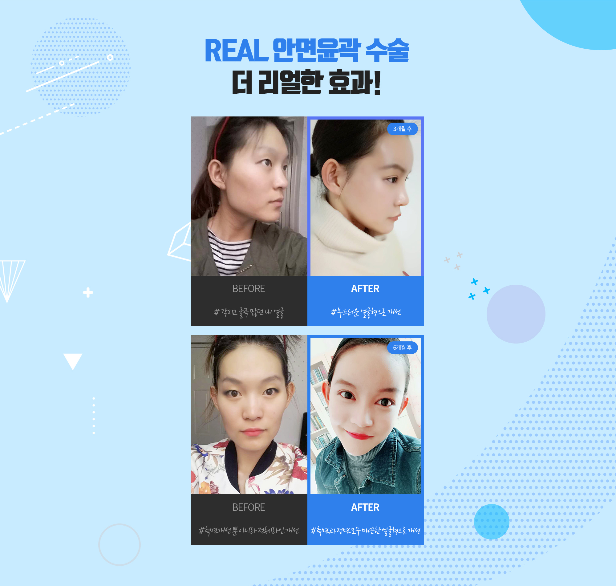 REAL 面部轮廓手术 更真实的效果! — 现代美学 方颌缩小术 REAL 前后照片