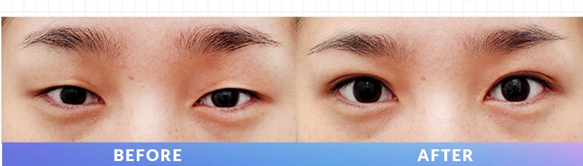 比较 Ten Minutes 自然粘连前后眼型的 Instagram 帖子图片