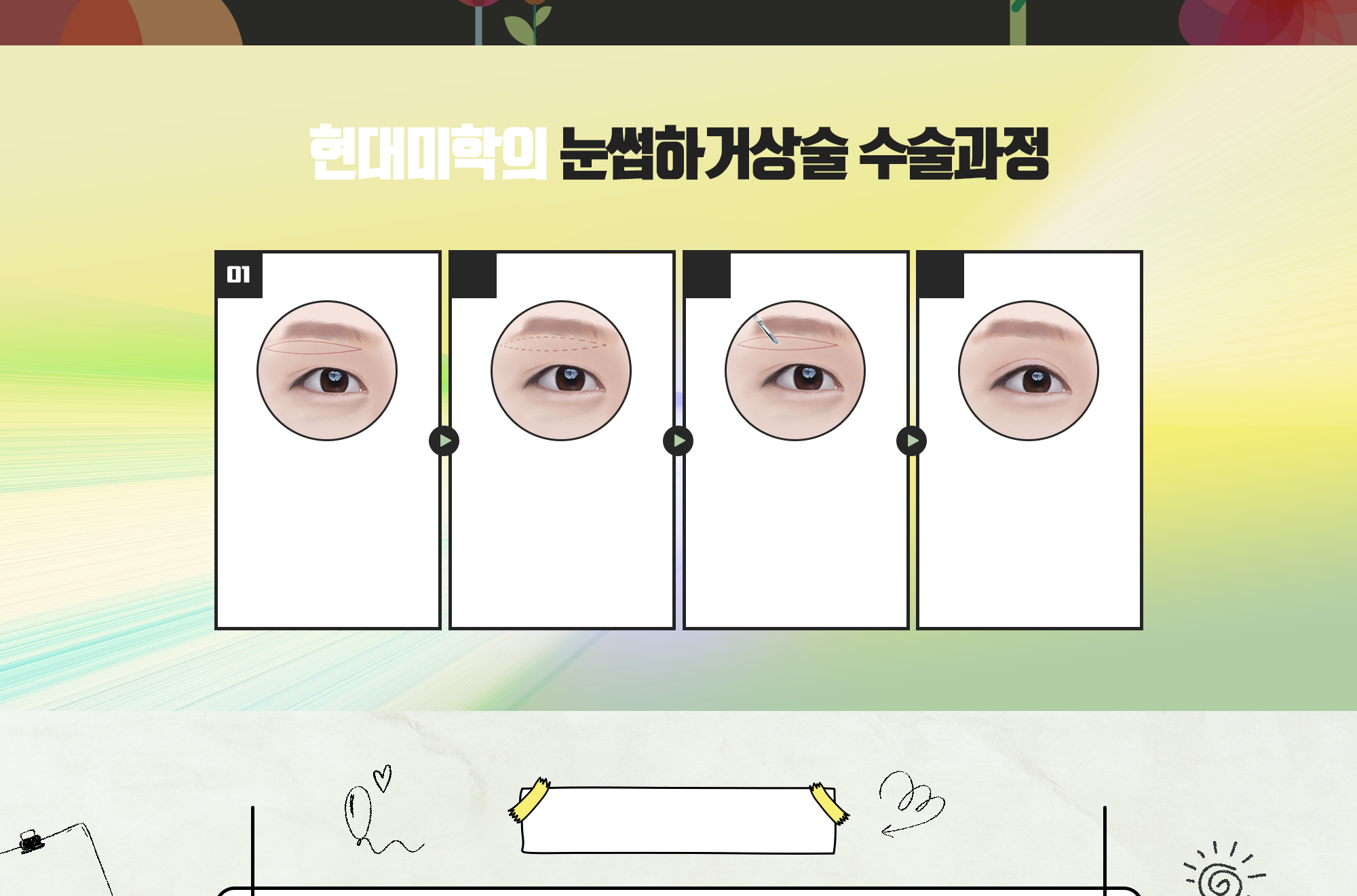 现代美学的眉下提升术手术过程 — 4阶段手术过程插图