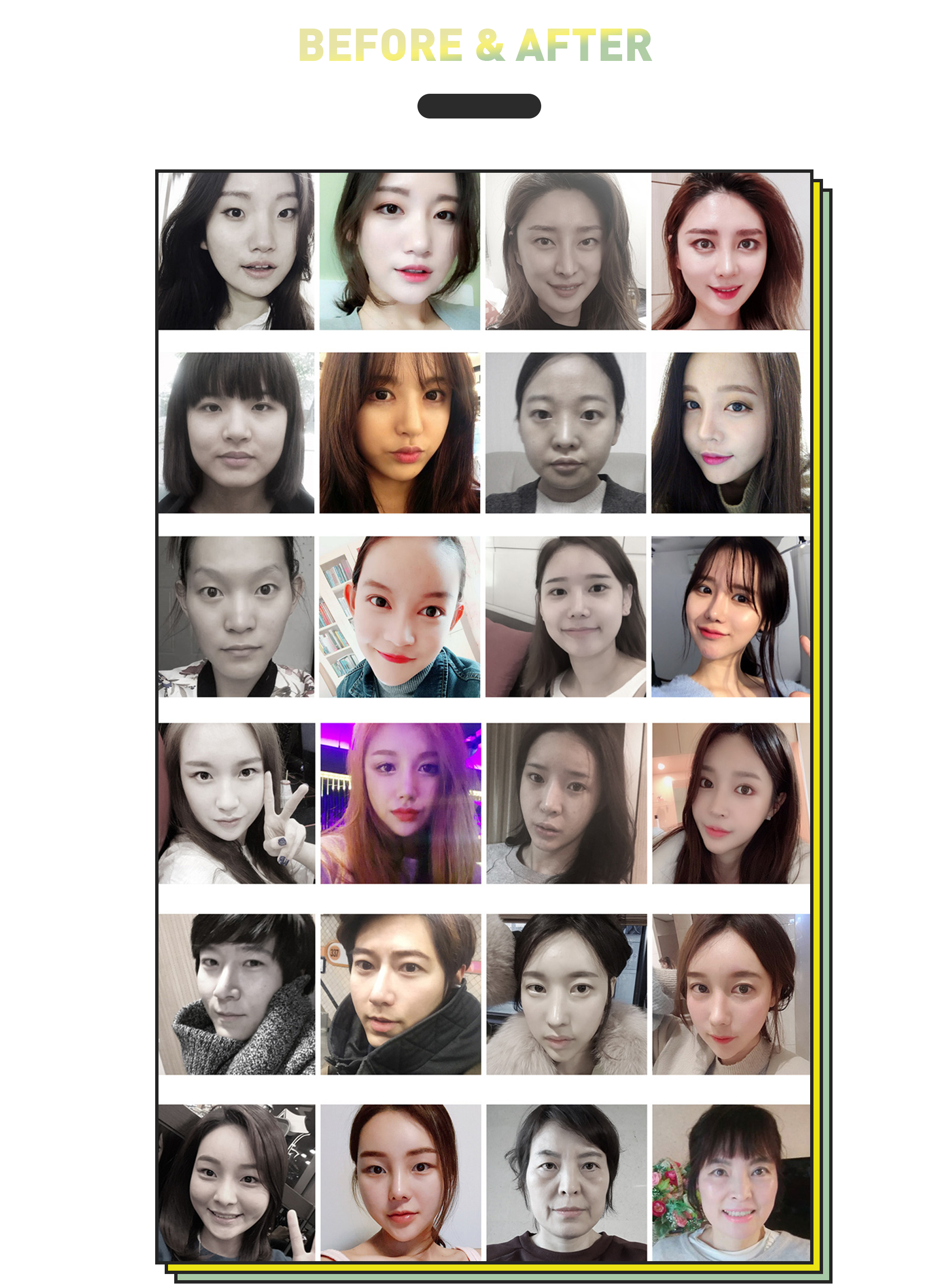 BEFORE & AFTER — 眉下提升术前后对比照片集(术后3个月)