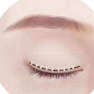 切开双眼皮手术 STEP 03 固定·缝合阶段插画