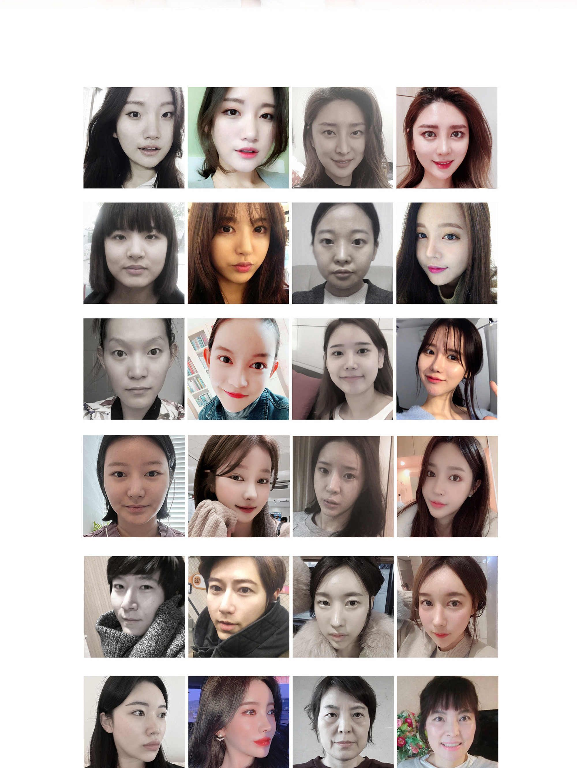唇部不对称矫正术 Before & After 案例