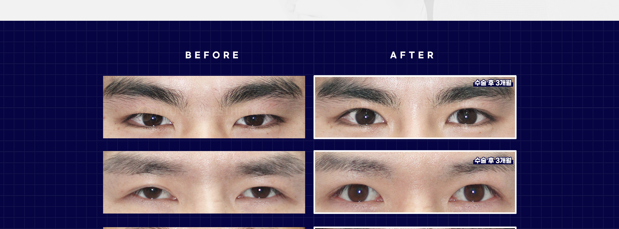 男士眼部整形 BEFORE & AFTER — 术后3个月