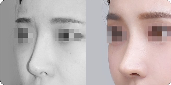 无假体鼻整形前后侧面比较 2 (BEFORE / AFTER 3MONTH)