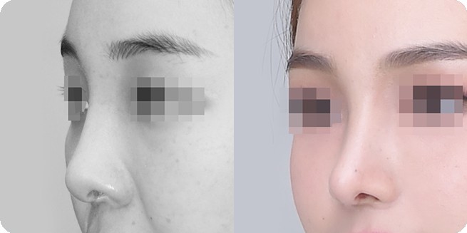 无假体鼻整形前后侧面比较 3 (BEFORE / AFTER 3MONTH)