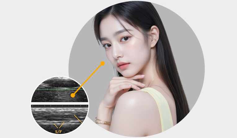 考虑面部整体平衡的提升设计 — 通过实时超声影像确认起始点